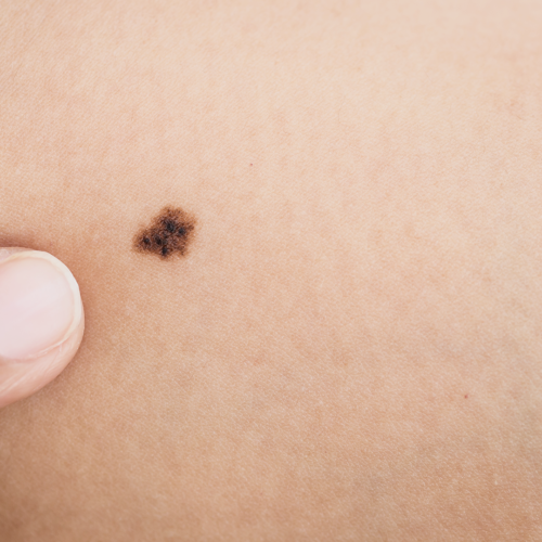 melanoma-skin-cancer