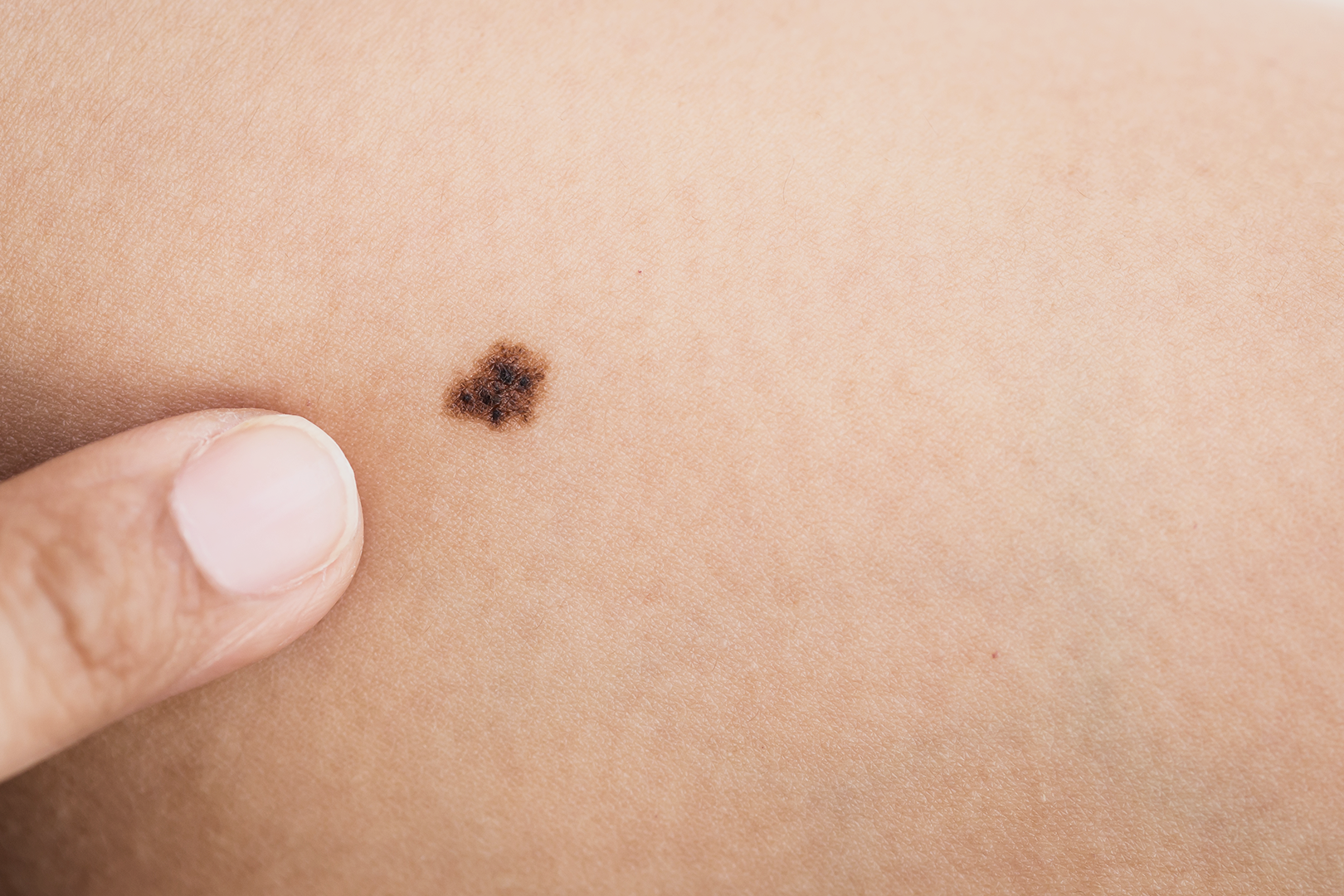 The Types of Skin Cancer: Learn How to Protect Yourself